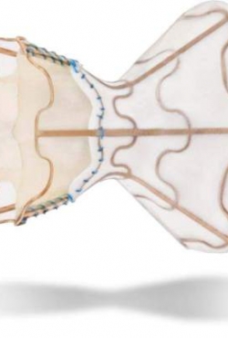 תוצאות ראשונות בבני אדם של הדלף הבין פרוזדורי של V-Wave פורסמו בכתב העת לנסט