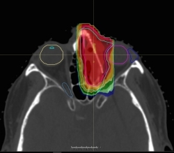 מביון מקבלת אישור 510(k) עבור סריקת קרן עיפרון HYPERSCAN