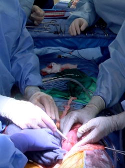 UAB מכריזה על ההשתלה הקלינית הראשונה של כליות חזיר בעריכת גנים לאדם עם מוות מוחי