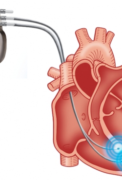 Impulse Dynamics מקבלת אישור MRI מותנה בגוף מלא עבור Optimizer Smart Mini System